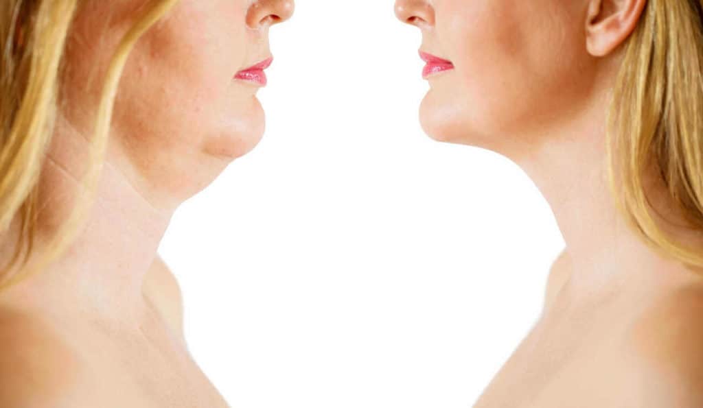 Double Chin treatment West Midlands before and after results