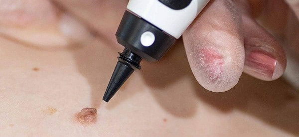 After Skin Tag Removal West Midlands
