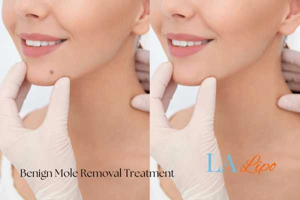 Before-and-after results following benign mole-removal treatment West Midlands