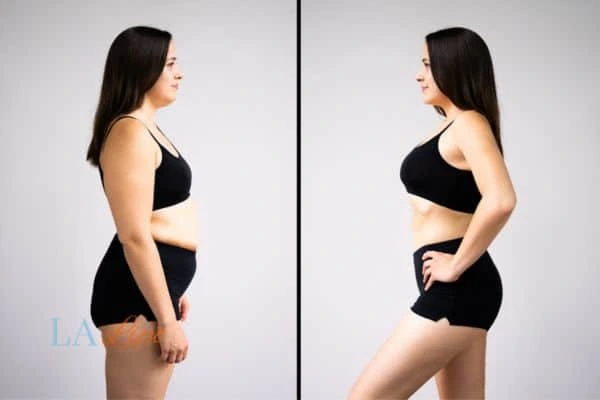 image of woman before and after results of LA-EMS Body Sculpting West Midlands to help treat Diastasis recti