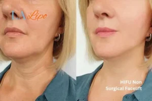 hi-fu for wrinkles West Midlands before and after results