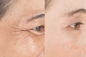 Before and after results of woman - HI-fu wrinkles reduction treatment West Midlands