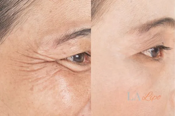 Before and after results of woman - HI-fu wrinkles reduction treatment West Midlands