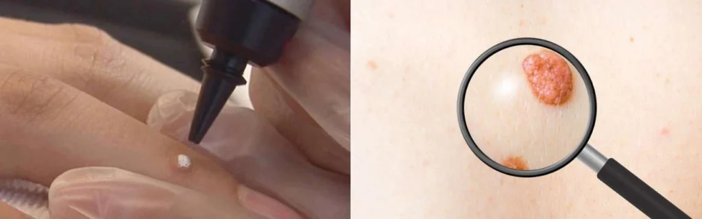 CryoPen practitioner West Midlands assessing a benign mole before treatment