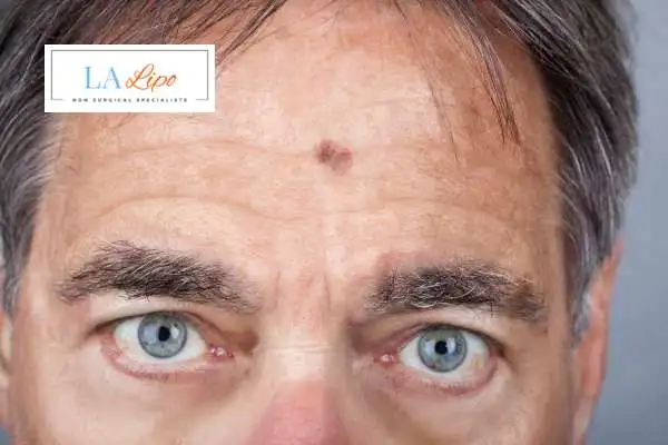Solar Lentigo Removal West Midlands image of man with mark on his forehead