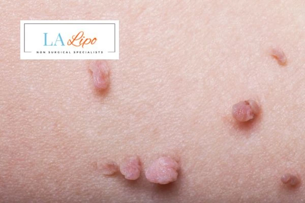 Does cryopen skin tag removal West Midlands hurt? Find out now call our team today!