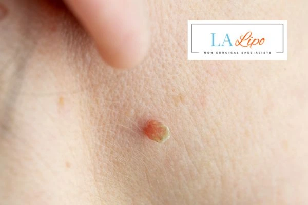 Book skin tag removal West Midlands today speak to our team now!