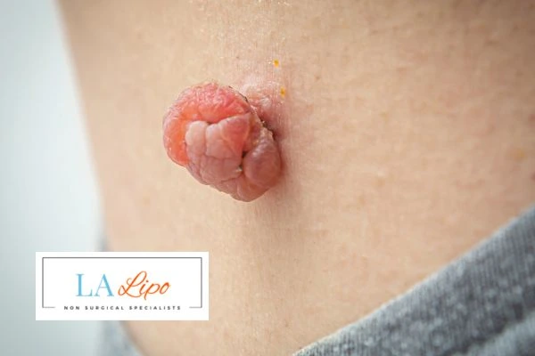 Interested in skin tag removal West Midlands? Concerned about the pain? Find out more today!