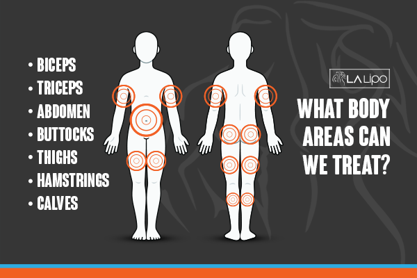 Diagram to show areas you can have LA-EMS Body Sculpting Treatment West Midlands
