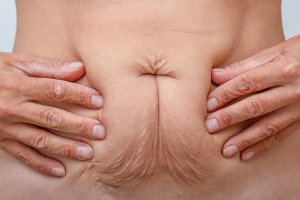 Should I Combine Diastasis Recti Treatment with Body Contouring for Better Results West Midlands?